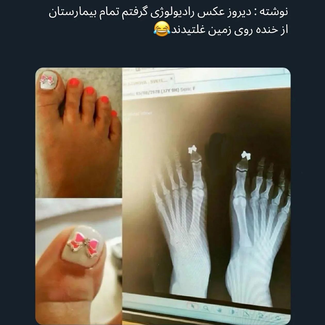 کاشت ناخن پا روی عکس رادیولوژی بیمارستان چه تاثیری دارد ؟